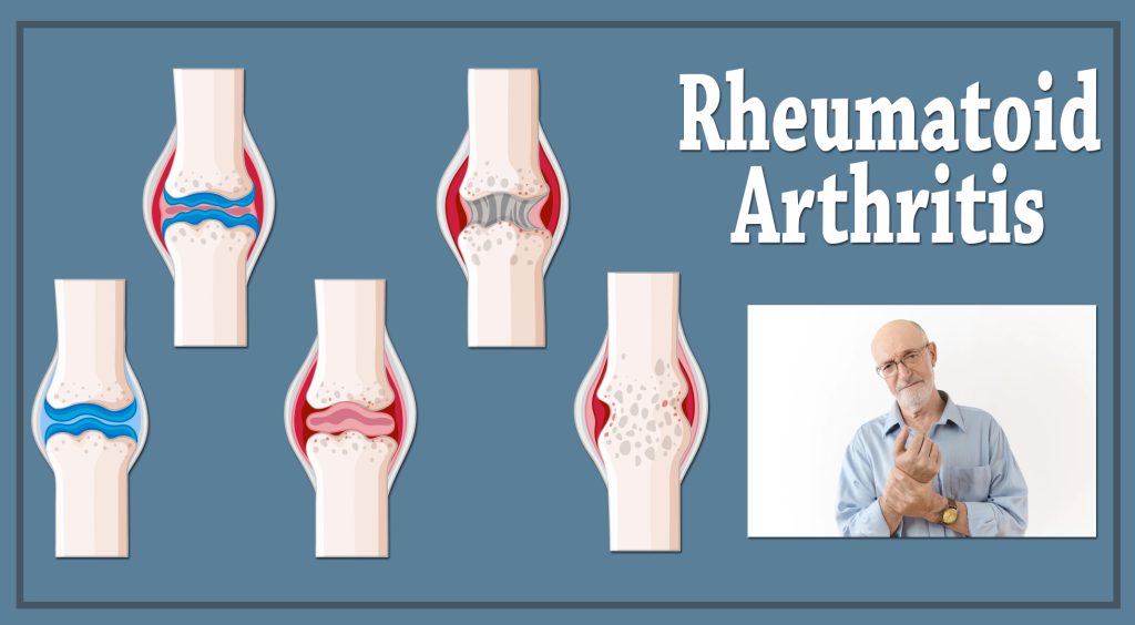 11 Can a Car Accident Cause Rheumatoid Arthritis