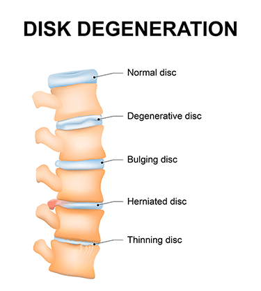 375. Degenerative disc disease caused by car accident