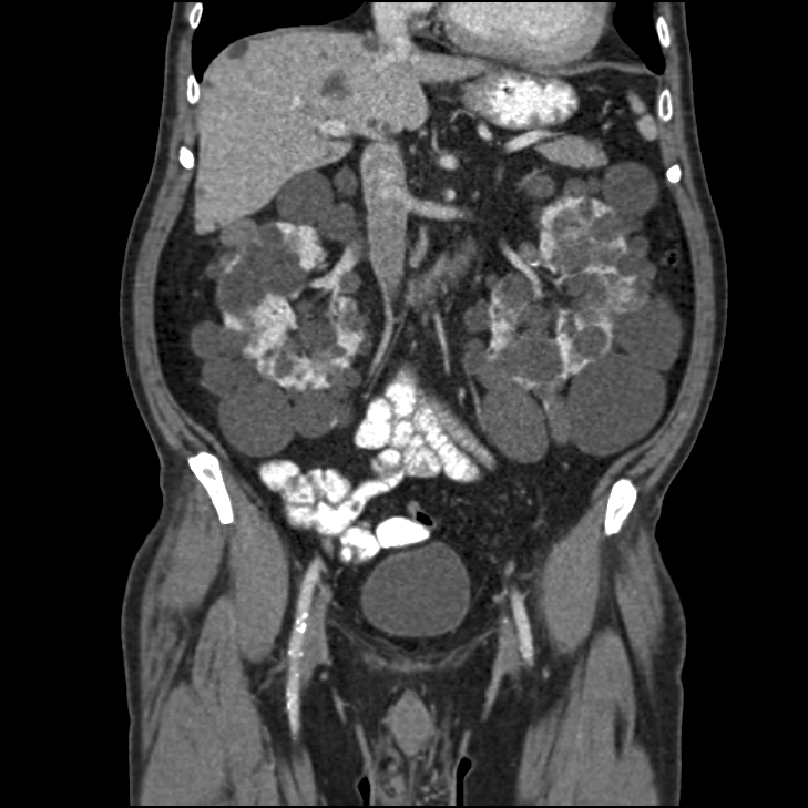 CT scan autosomal dominant polycystic kidney disease