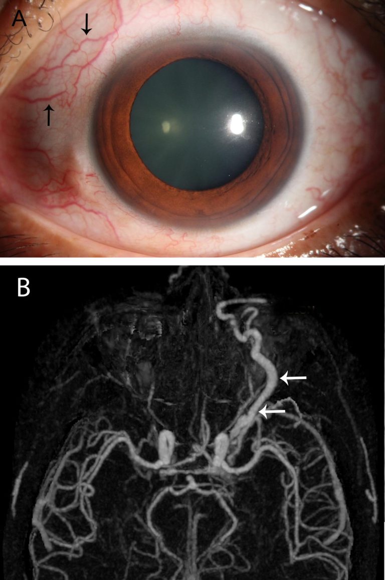 Can Head Injury Cause Red Eyes?