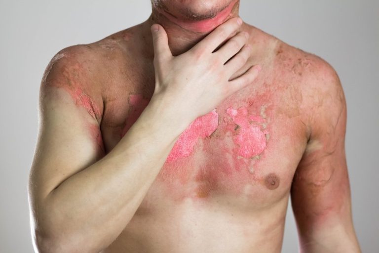 How Much Compensation Do You Get For A Burn Injury?