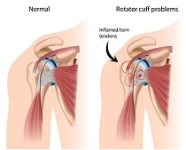 shoulderimpingment