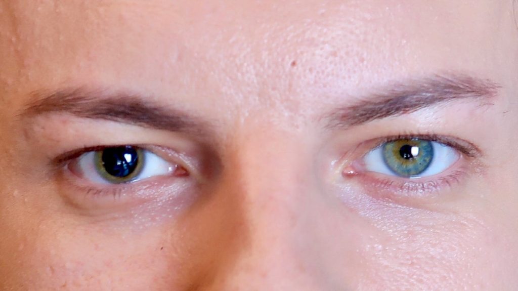 single pupil dilated anisocoria body2