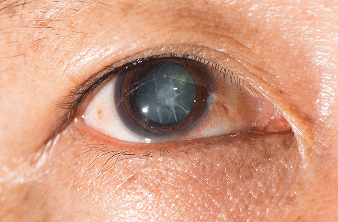 traumatic cataract 678x446 1