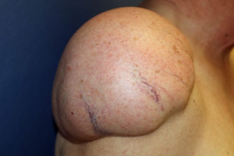 Can Lipoma Misdiagnosis