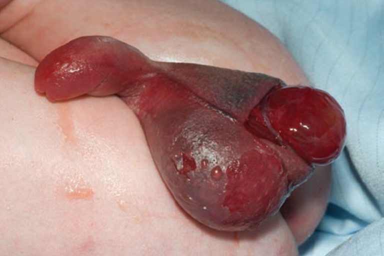 Can Testicle Injuries Lead To Birth Defects?