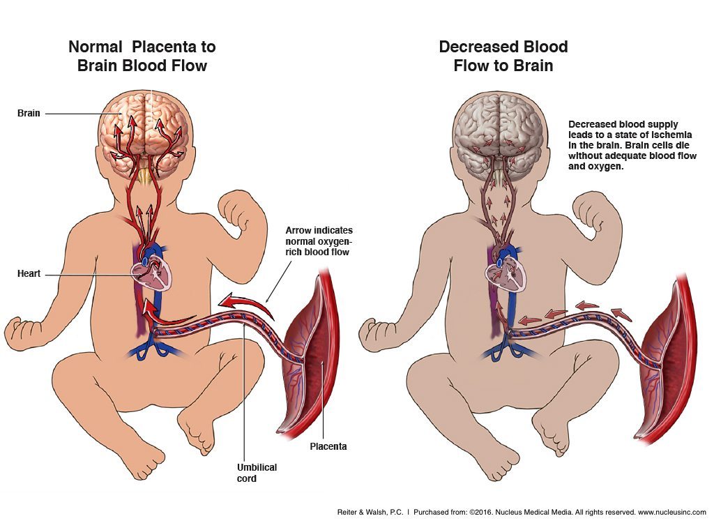 Fetal Brain Injury Due to Decreased Blood Flow Ischemia