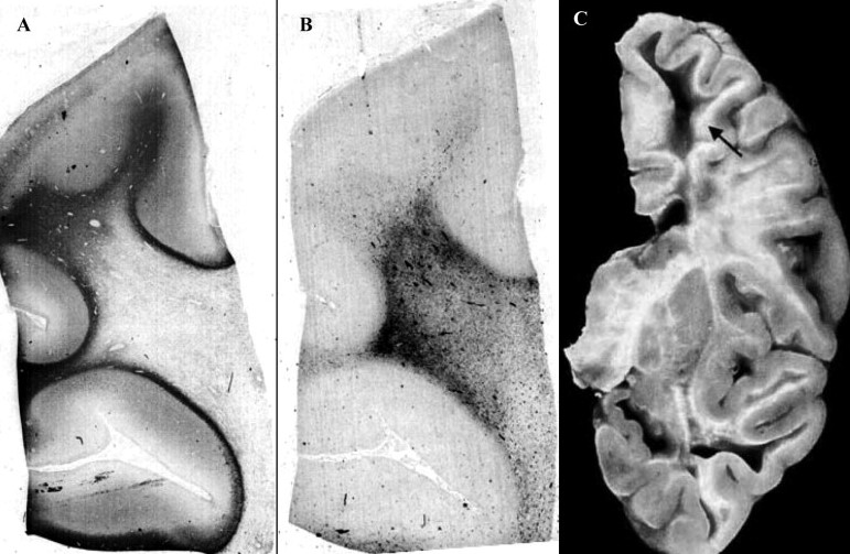 Is It Possible To Have A Misdiagnosis Of Leukodystrophy