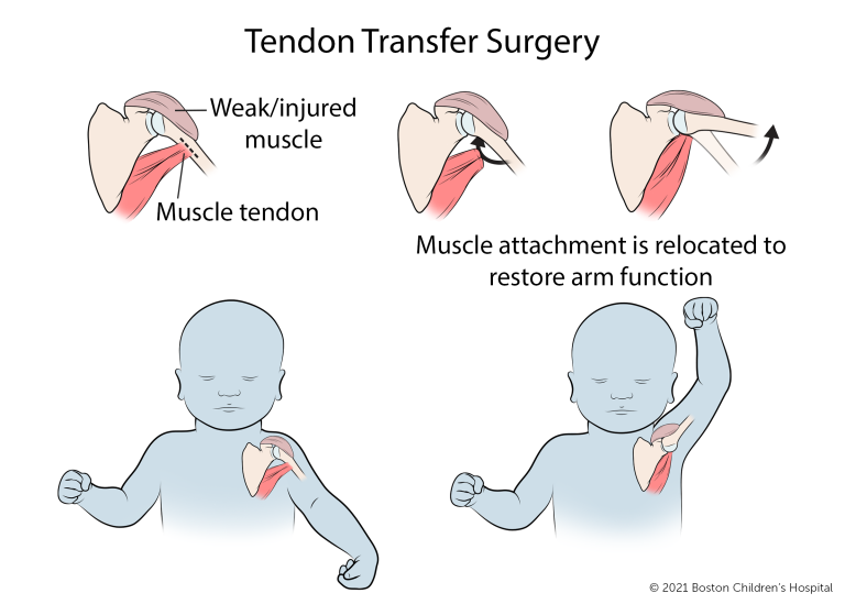 What Is A Brachial Plexus Injury At Birth?