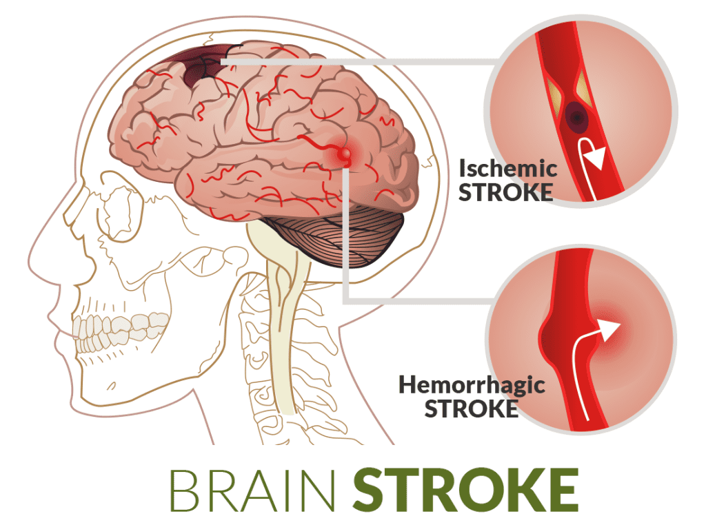 brain stroke diagram e1442999423753 1024x765 1024x765 1