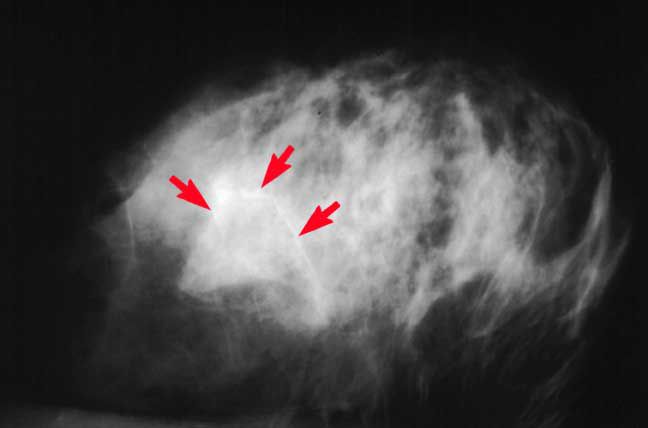 calcifications 56a0b6835f9b58eba4b30bc3