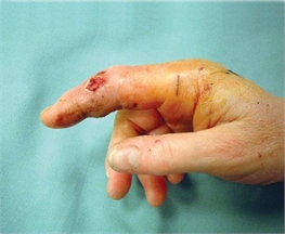 cat bite finger infection