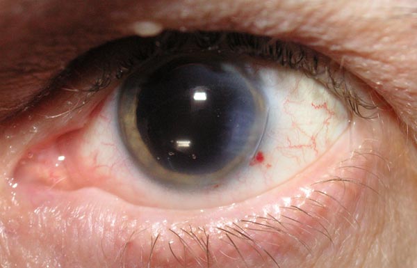 Can You Get A Misdiagnosis Cataracts?