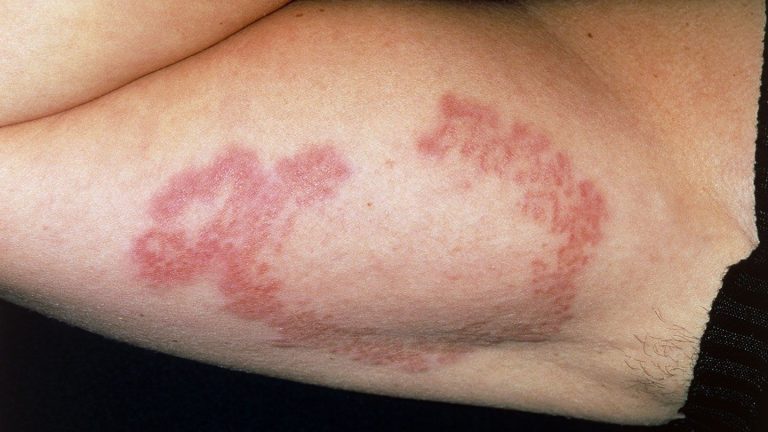 Can A Rash Lead To A Misdiagnosis Of Diabetes?