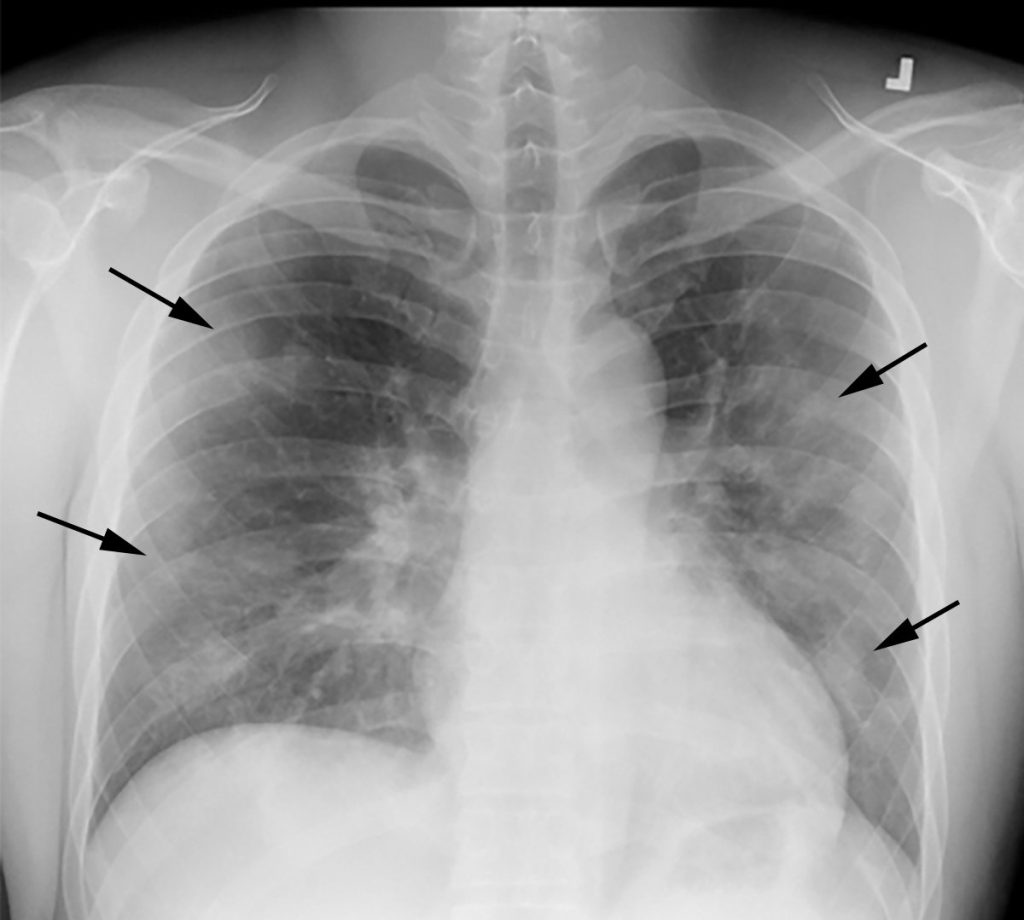 fig.202a20lung X ray COVID Rezvin 0