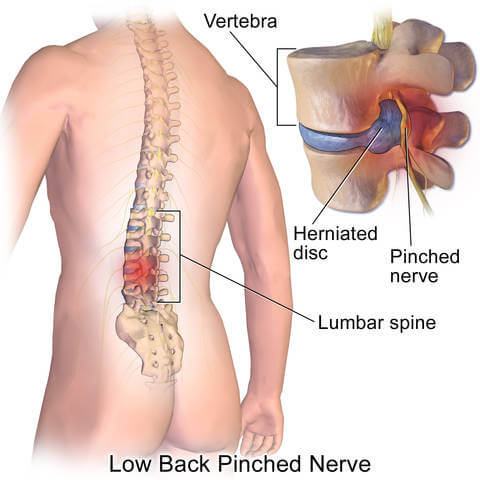 herniated disc