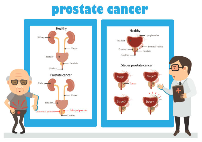 illustration about prostate cancer