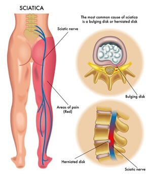 Can A Slip And Fall Cause Sciatica?