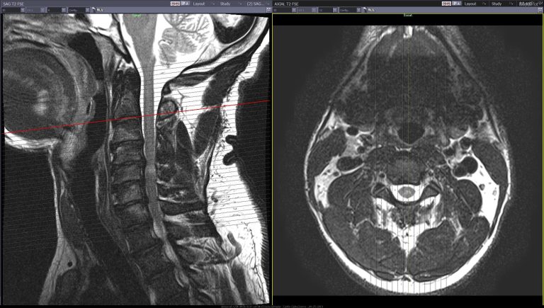 Can A Pedestrian Car Accident Cause Myelomalacia?