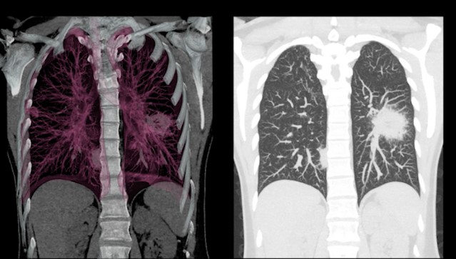 How To Avoid Misdiagnosis Of Lung Cancer Or Overdiagnosis