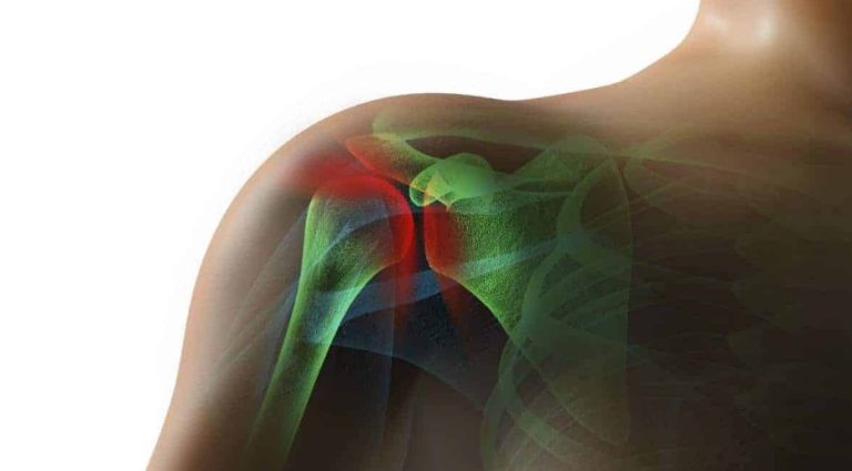 Can A Car Accident Cause A Rotator Cuff Tear